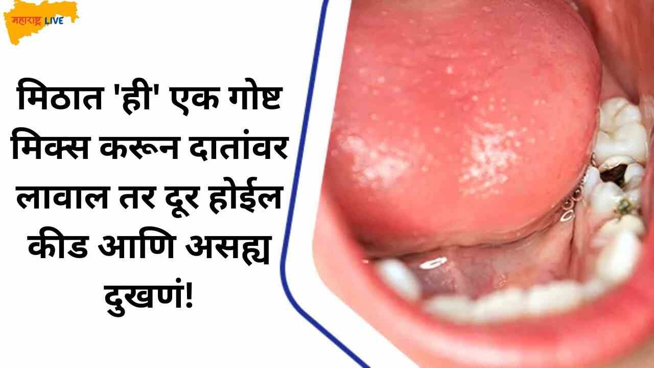 Tooth cavity home remedies